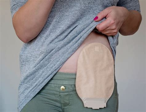 gucci colostomy bag|colostomy bag dressing.